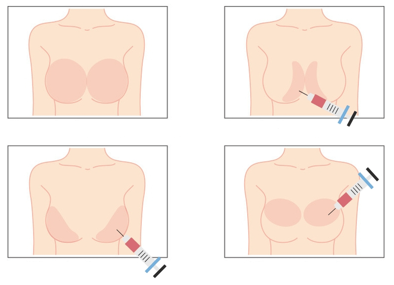Hyaluronik asitin memeye enjeksiyonu için yerler