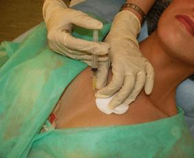 Mezo-kokteylin meme dokusuna uygulanması - hyaluronik asit enjeksiyonlarına bir alternatif