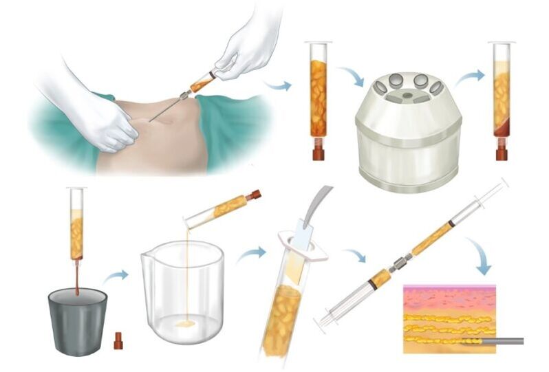 Sorunlu bölgelerden yağların alınması, işlenmesi ve meme dokusuna enjeksiyonu