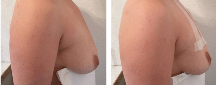 İple meme dikleştirme öncesi ve sonrası