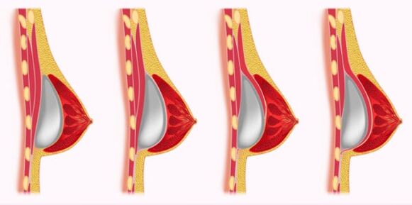 göğüs büyütme için implant yerleştirme yöntemleri